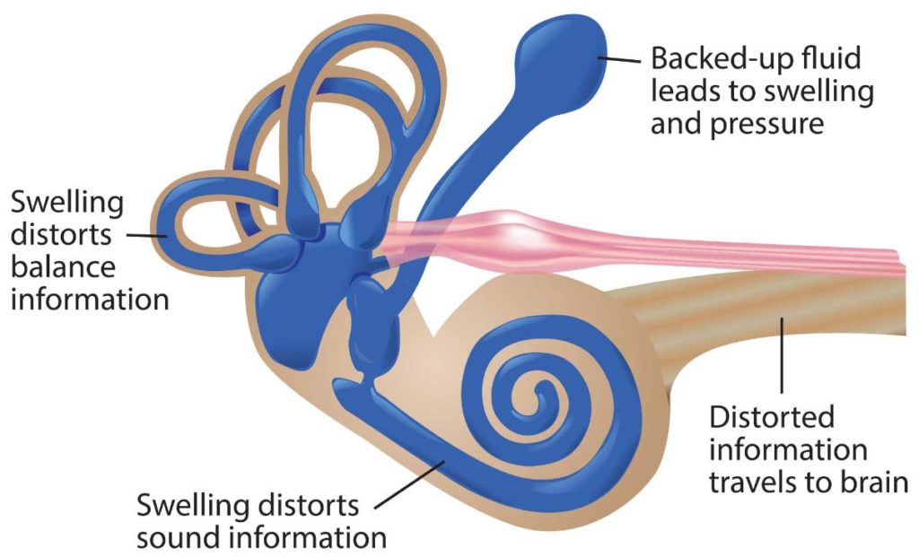 Meniere Disease Economou Hearing Centres